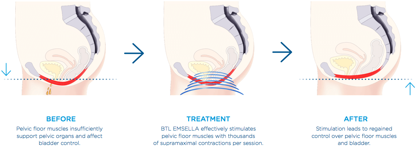 EMSella Treatment for Urinary Incontinence